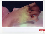 Defendant's Exhibit 109-13: Injuries To Marilyn's Hand by Cuyahoga County Coroner's Office