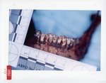 Defendant's Exhibit 173: Damaged Teeth by Cuyahoga County Coroner's Office