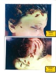 Plaintiff's Exhibit 2008 & 2012: Right side of Marilyn's face at autopsy; Marilyn's head at autopsy by Cuyahoga County Coroner's Office