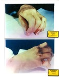 Plaintiff's Exhibit 2015 & 2017: Marilyn's avulsed fingernail; Marilyn's right hand by Cuyahoga County Coroner's Office